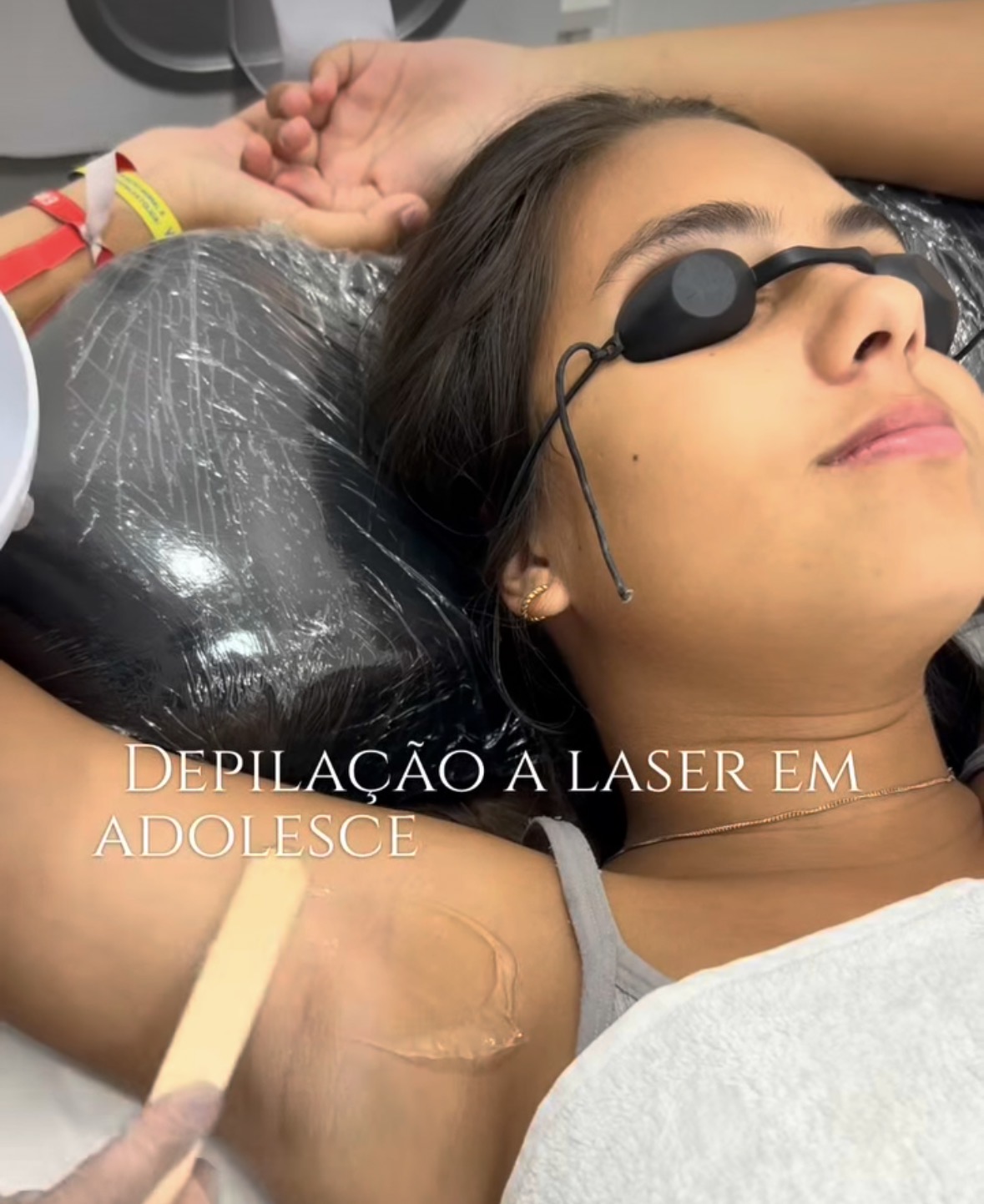 Depilação a Laser